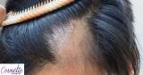 آیا روش های درمان ریزش مو مؤثرند؟