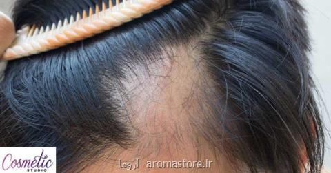 آیا روش های درمان ریزش مو مؤثرند؟