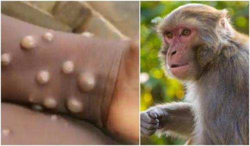 نشانه های مبتلاشدن به آبله میمون
