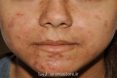 ارتباط مصرف لبنیات و غذاهای چرب با بروز آكنه در بزرگسالان